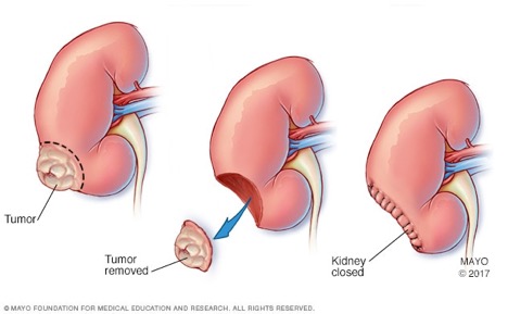cirugia-de-rinon-para-tratar-el-cancer