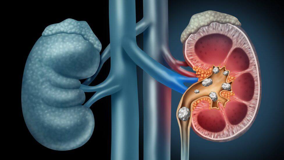 urology - calculos o piedras en vias urinarias