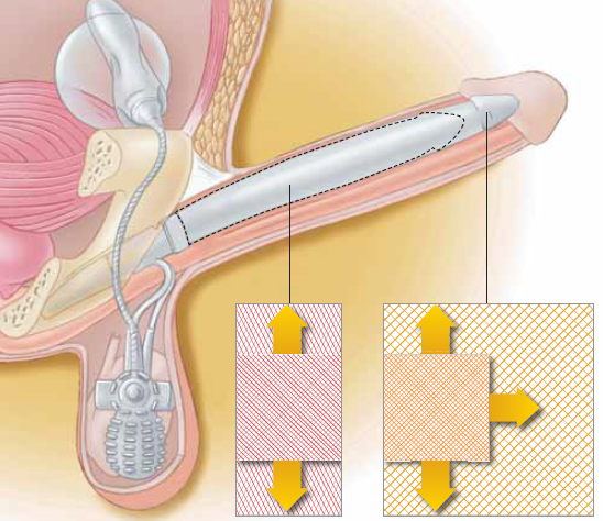 como-funcionan-los-implantes-o-protesis-de-pene